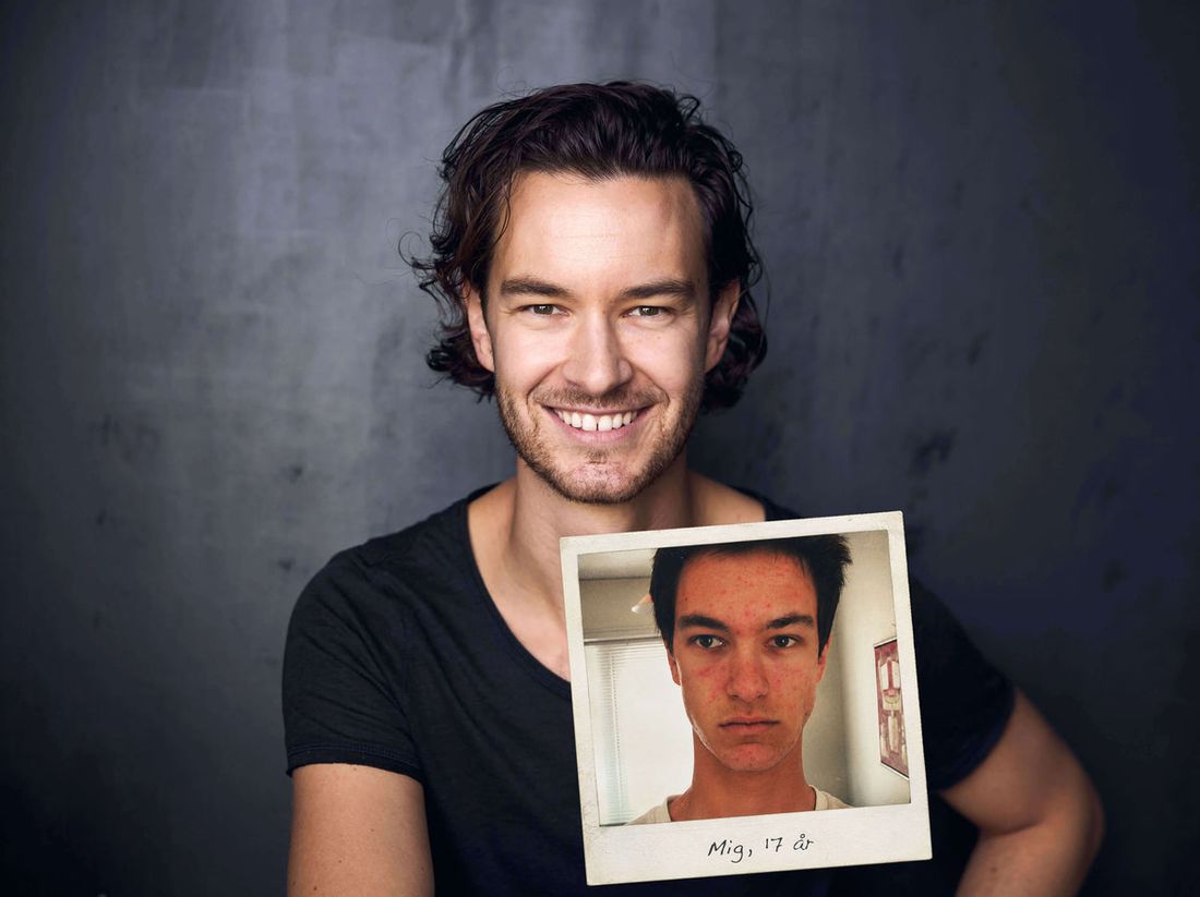 Mads Timmermann holder et polaroid af sig selv fra dengang, han kæmpede med sin hud